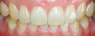 whitening